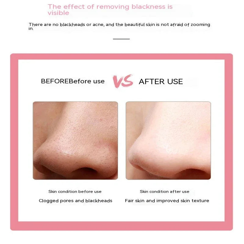 Ergonomic Facial Blackhead Acne Removal Skin Beauty Instrument